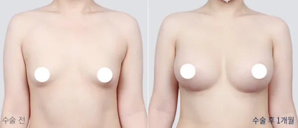 Before/After