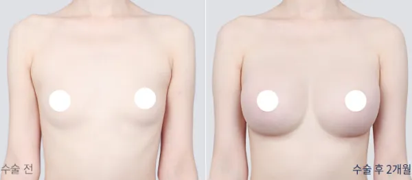 Before/After