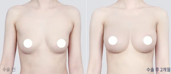 Before/After