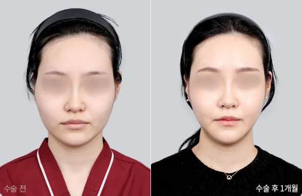 Before/After