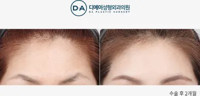 Before & After