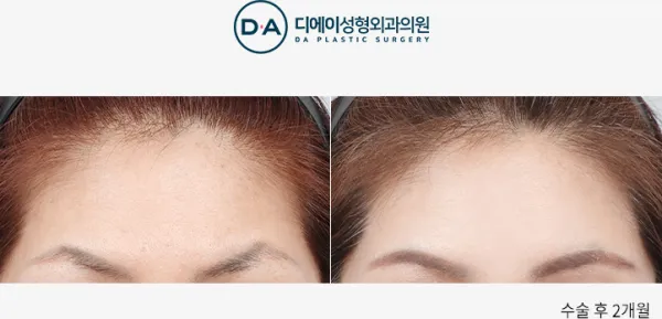Before/After