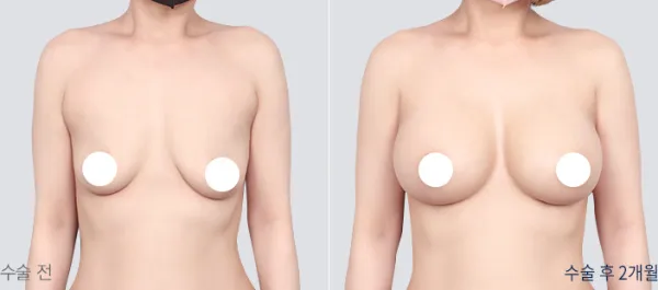 Before/After