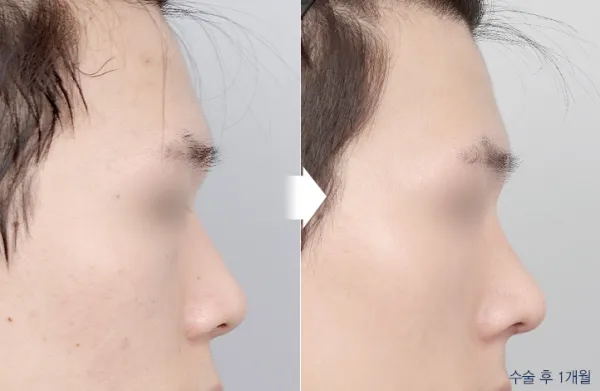 Before/After
