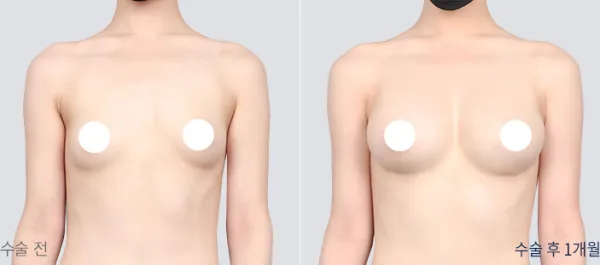 Before/After