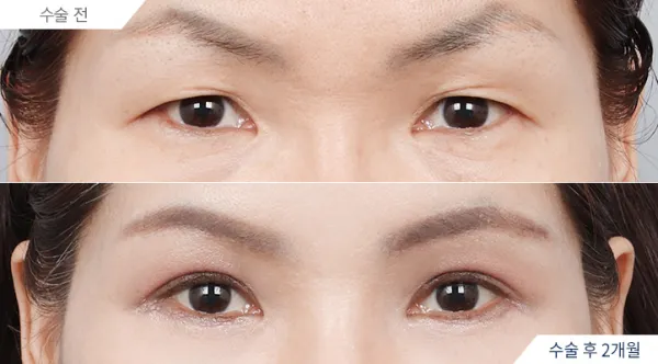 Before/After
