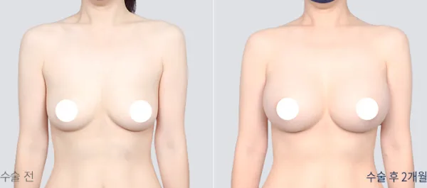 Before/After