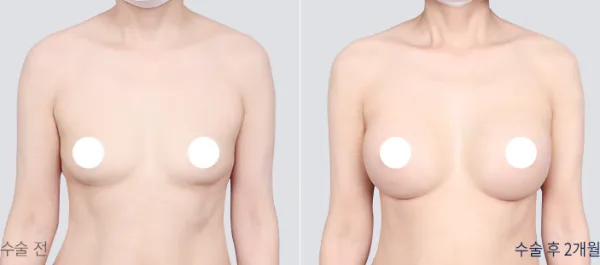 Before/After