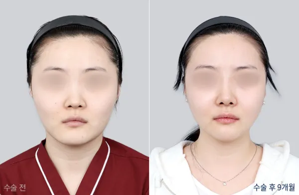 Before/After