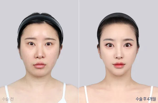 Before/After