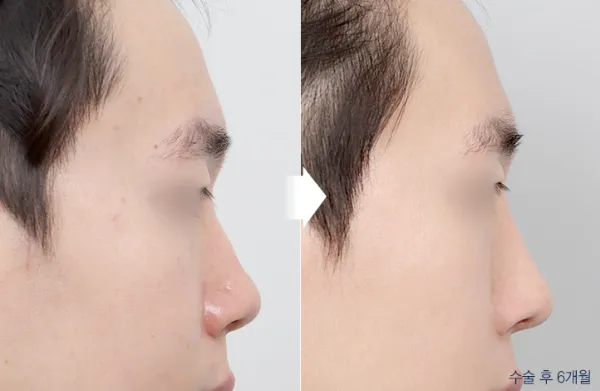 Before/After