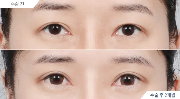 Before/After