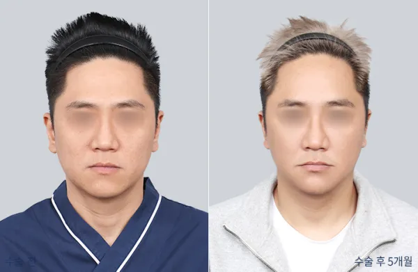 Before/After
