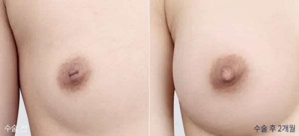 Before/After