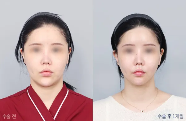 Before/After