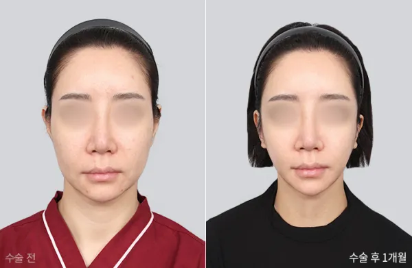 Before/After