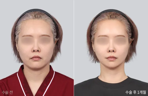 Before/After