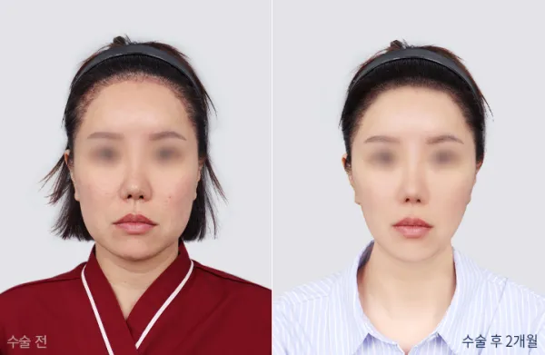 Before/After