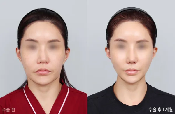 Before/After