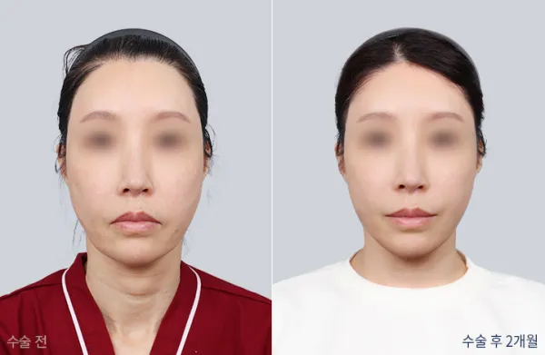 Before/After