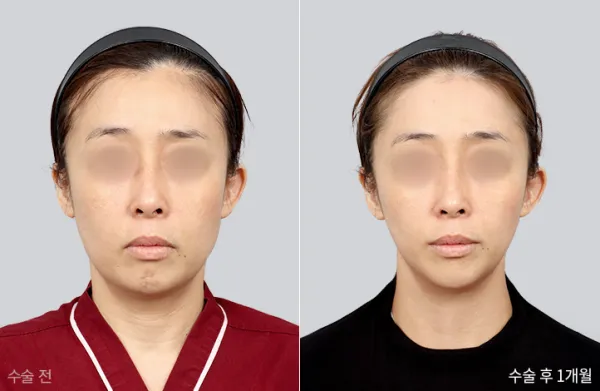 Before/After