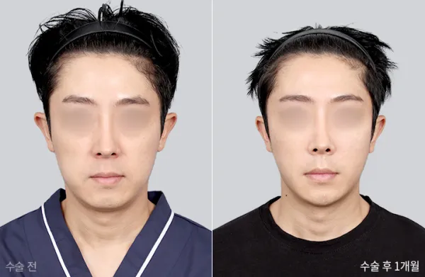 Before/After