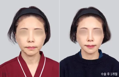 Before & After