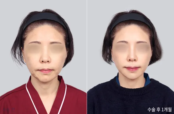 Before/After