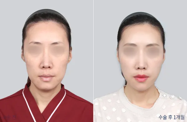 Before/After