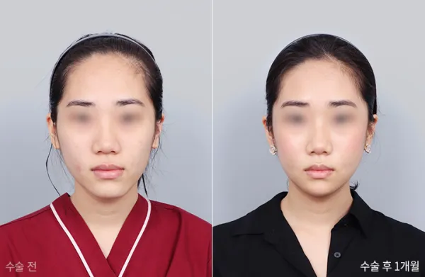 Before/After