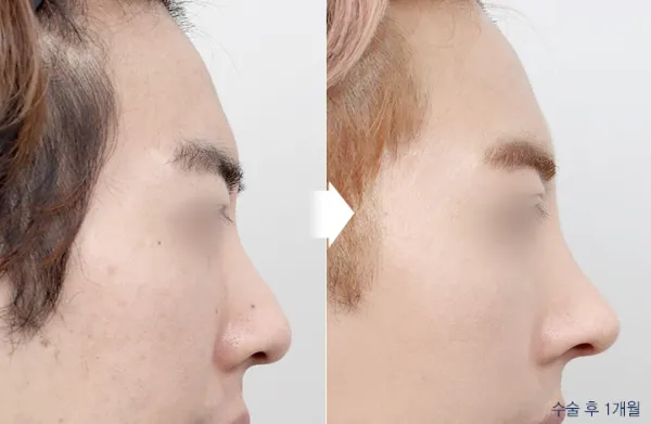 Before/After