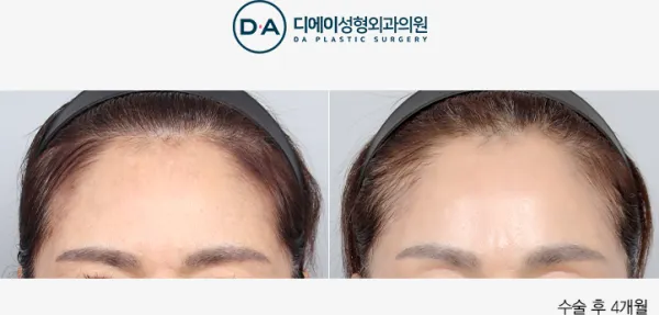 Before/After