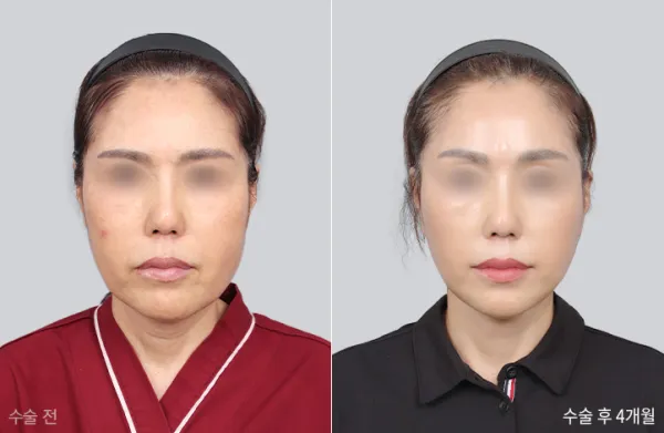 Before/After