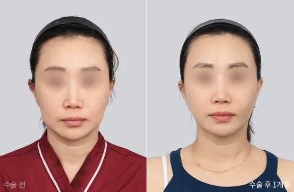 Before/After