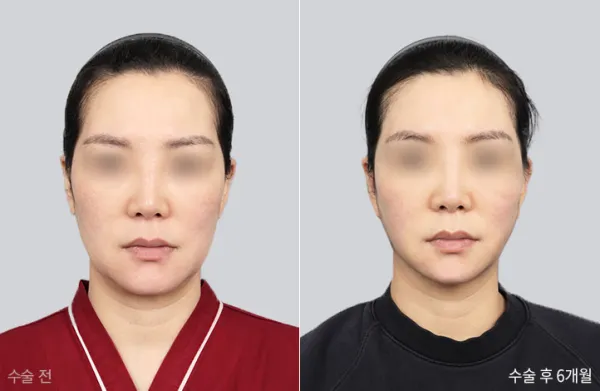 Before/After