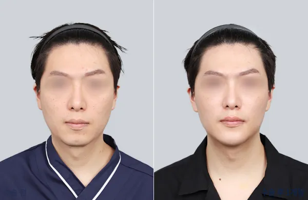 Before/After
