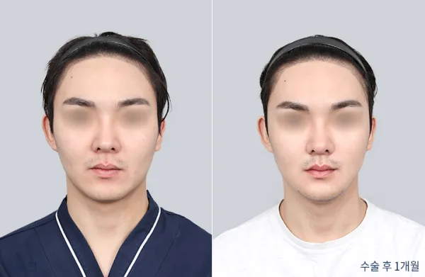 Before/After