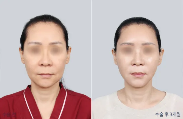 Before/After