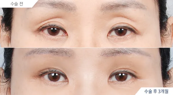 Before/After