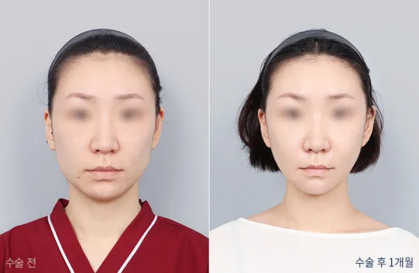 Before/After