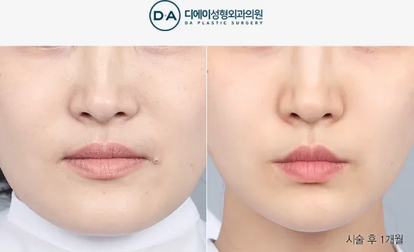 Before/After