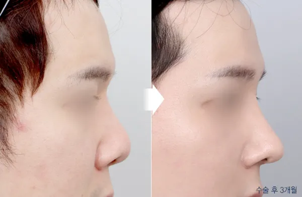 Before/After