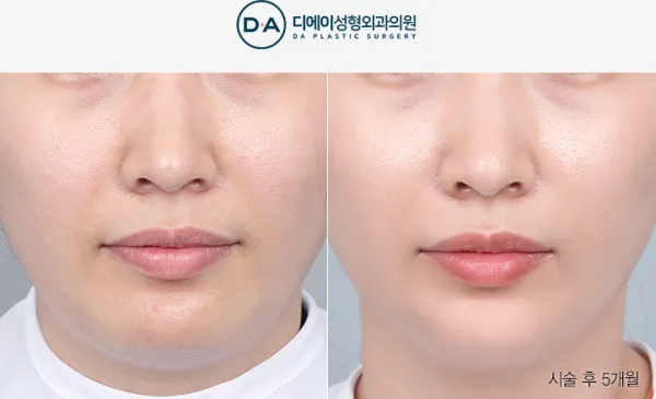 Before/After