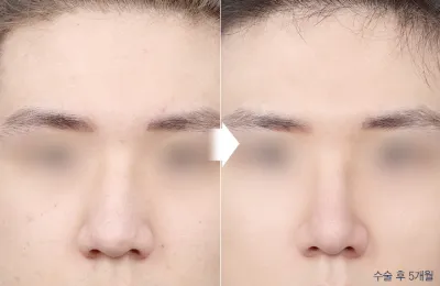 Before & After