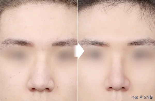 Before/After