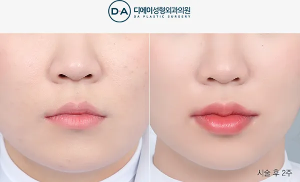 Before/After