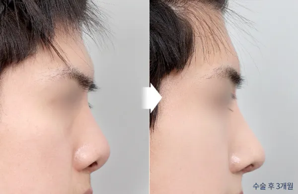 Before/After