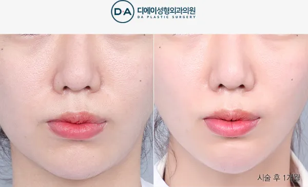 Before/After