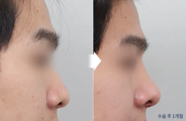 Before/After