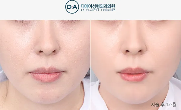 Before/After